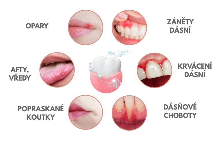 OROXID forte gel proti zánětu dásní